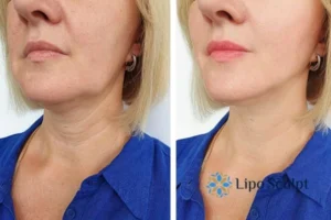 Double chin before and after Hi-Fu treatment 4 Book your double chin treatment Balsall today! We are here to help!