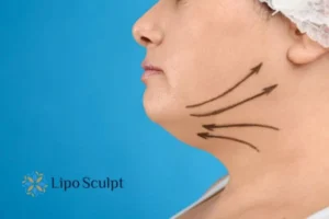 Double chin before and after Hi-Fu treatment 3 Boost your confidence with a Double chin treatment Balsall