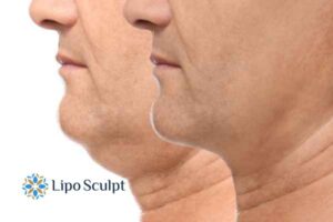 Double chin before and after Hi-Fu treatment 2 Double chin treatment Balsall from Lipo Sculpt - feel more confident today!