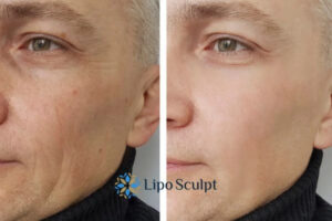 How to Fight Aging Symptoms 3 Fight Aging Symptoms Balsall With HIFU and Morpheus8 Today!
