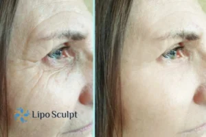 How to Fight Aging Symptoms 2 Do you want to Fight Aging Symptoms Balsall? Contact Lipo Sculpt today!