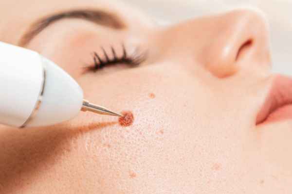 CryoPen: 5 Skin Concerns It May Be Used to Treat 3 What actually happens during a CryoPen treatment Balsall?