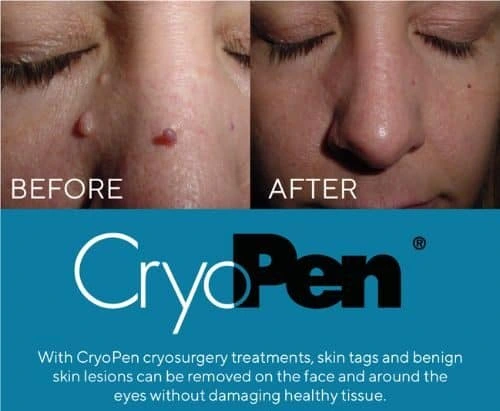 image of angiofibroma removal Balsall using Lipo Sculpt cryopen!